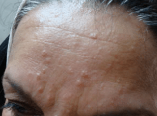 white bumps on face