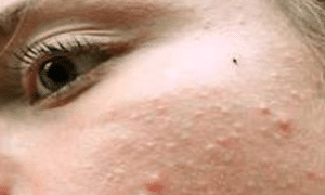white-spots-on-face-picture-2