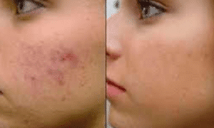 before-and-after-hydrogen-peroxide-for-pimple-marks-2