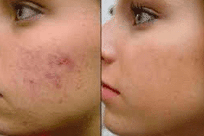 how to get rid of pimple marks