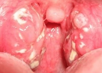 white patches on tonsils