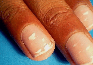 white spots on fingernails