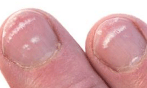 white-spots-on-nails-1-2