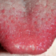 white-spots-on-tongue-2