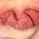 white-spots-on-tonsils-2