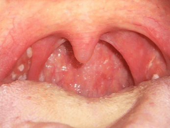 white-spots-on-tonsils-2