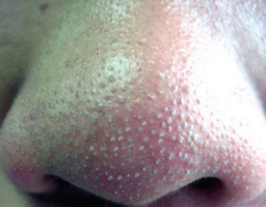whiteheads on nose causes