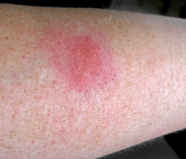allergy to mosquito bites