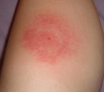 mosquito-bite-allergy-2