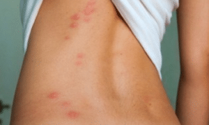 bedbugs-bite-picture-2