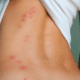bedbugs-bite-picture-2
