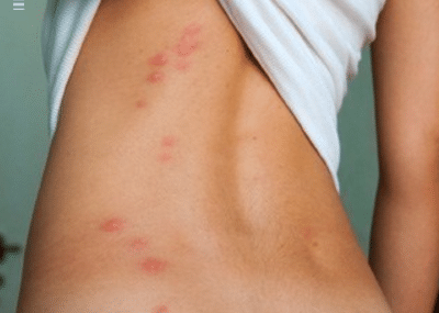 bedbugs bite picture