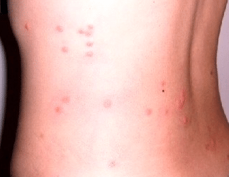 flea bites on human itch
