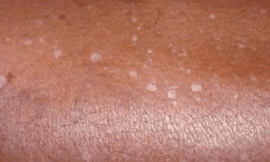 small-white-spots-on-skin-1-2