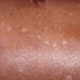 small-white-spots-on-skin-1-2