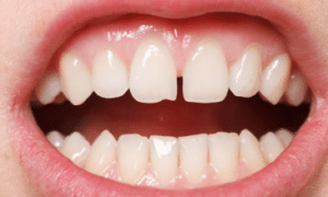 white-dots-on-gums-2