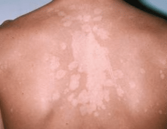 white patches on skin
