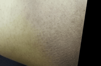 dark inner thigh whitening