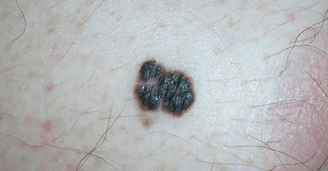 black spots on legs