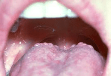 bumps on back of tongue