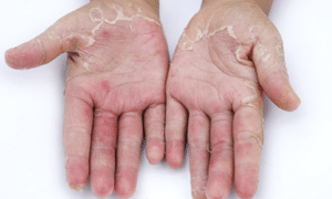 causes-of-peeling-hands-1
