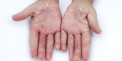 causes of peeling hands