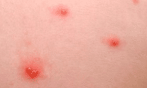 causes-of-red-spots-on-skin-1