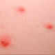 causes-of-red-spots-on-skin-1