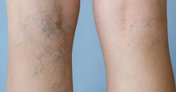 dark spots on legs