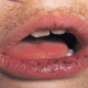 dark-spots-on-the-lips-1