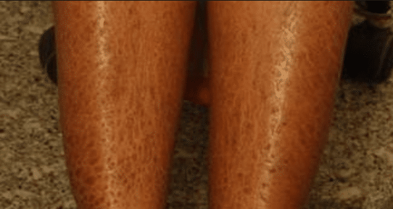 dry skin on legs