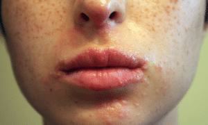 meaning-of-pimples-around-mouth-1