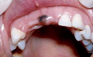 painful spot on gum