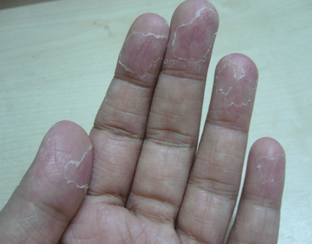 peeling fingertips
