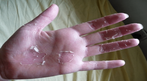 peeling hand