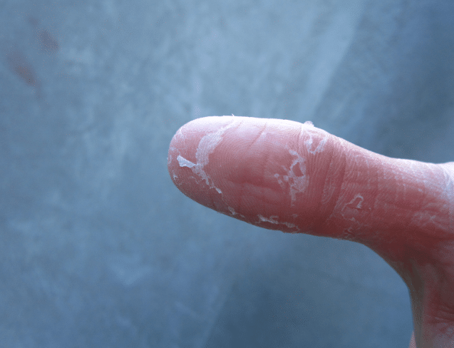 peeling skin on thumb