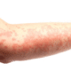 red-bumps-on-arm-1