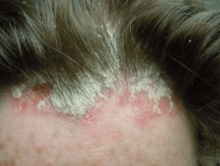 red patches on scalp