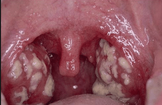 white bumps in back of throat