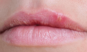 Blisters-on-lip