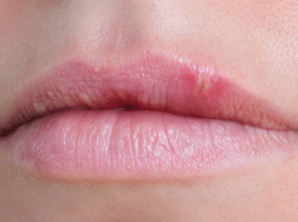 Blisters-on-lip