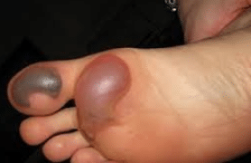 blisters-on-foot-1