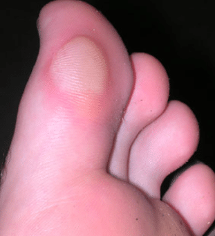 blisters on toe of foot