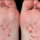 bumps-on-bottom-of-the-feet-1