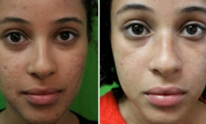 how-to-remove-black-spots-from-face-fast-1