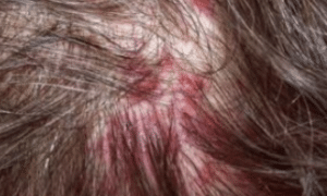 ingrown-hair-on-scalp-1