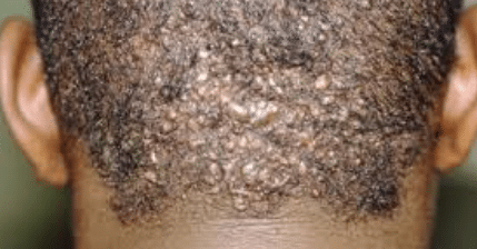 ingrown hair on the back of scalp