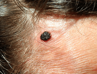 itchy mole on scalp