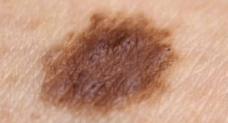 picture of mole cancer