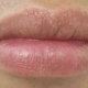 white-spots-on-lips-1